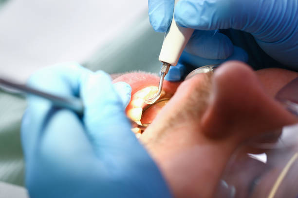 Best Emergency Root Canal Treatment in Seaside, CA